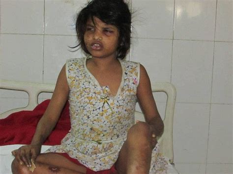 India’s latest feral child- what her doctors say - DailyRounds