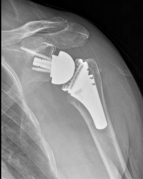 Physical therapy and its link to development of acromial fracture