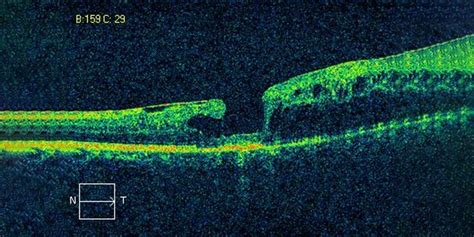 Macular Holes and Surgery: Treatment and Aftercare