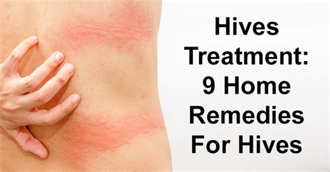 Hives Treatment: 9 Home Remedies For Hives - David Avocado Wolfe