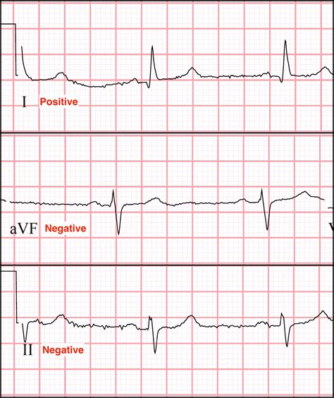 Axis Deviation Ekg Practice