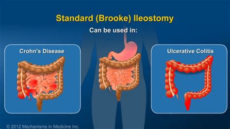 The standard (Brooke) ileostomy is performed most often and can be used ...