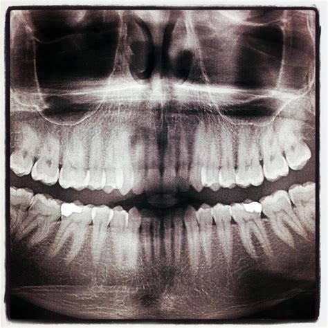 FroKnowsPhoto 3D Mouth X-Ray | SMILE!!!! This is how I spent… | Flickr