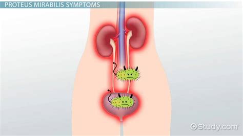 Proteus Mirabilis Infection: Causes, Symptoms & Treatment - Lesson ...