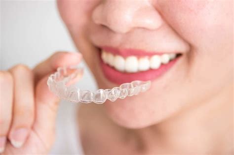 Invisalign Process and Timeline Behind Your Smile - Biid.org