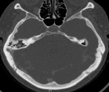 Sigmoid Sinus Diverticulum | Boston Medical Center