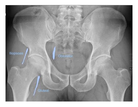 Normal Pelvis X Ray