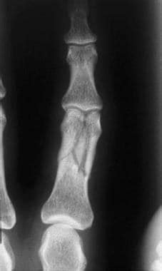 Compound Fractures X Ray