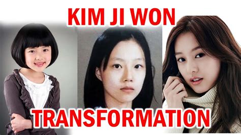 Kim Ji Won's Plastic Surgery Journey: Before And After Transformations