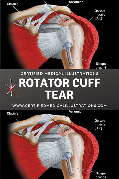Left Shoulder Rotator Cuff Anatomy