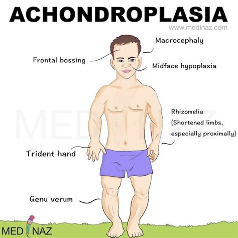 Achondroplasia – Artofit