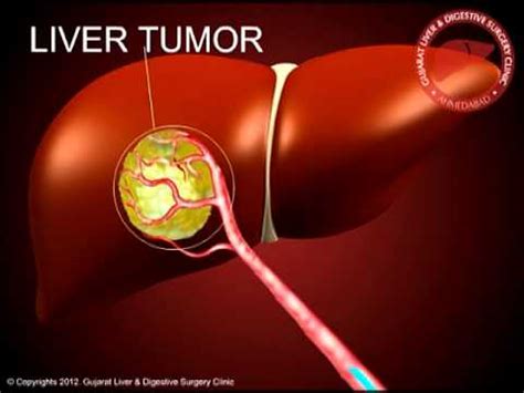 TACE ( By Gujarat Liver Cancer Clinic - Dr. Hitesh Chavda) - YouTube