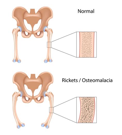 Hereditary hypophosphatemic rickets - Genetics Home Reference