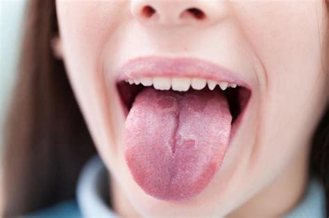 Burning Tongue – symptoms, causes and other risk factors