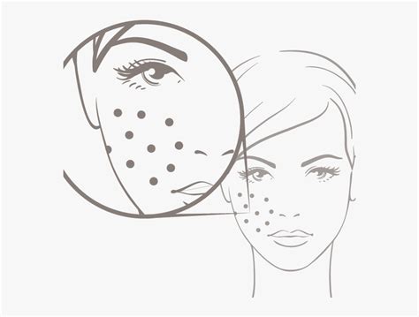 Acne Cliparts - Download Free Acne Images and Illustrations - Clip Art ...
