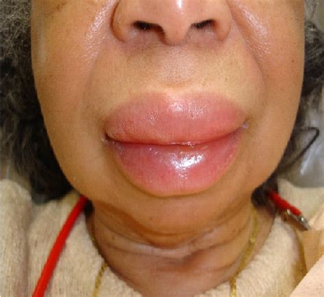 New Information About Angioedema - Gazette Review