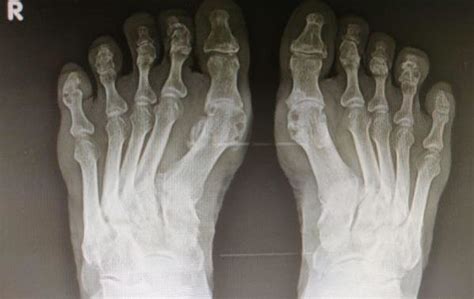 6 months follow-up x-ray of both feet shows no recurrence of tophi ...