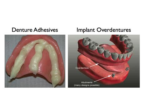 Denture Adhesives Or Two Dental Implants | Denture Adhesives Or Two Dental Implants - Kazemi ...