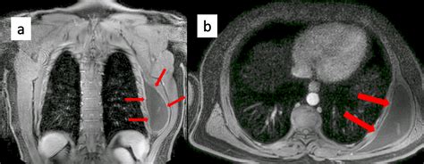 Cureus | A Rare Lesion of the Thoracic Wall: Giant Scapulothoracic Bursitis