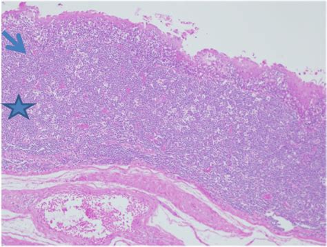 Branchial Cleft Cyst Histology