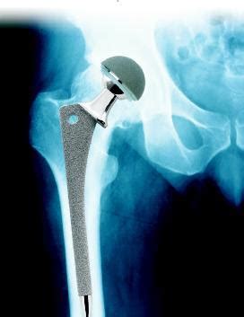Orthopedic Implants - Level 3 Inspection