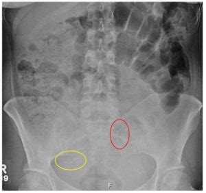 How far can Essure coils migrate through the body? Abdomen Uterus Cervix