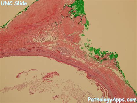 dermoid cyst pathology