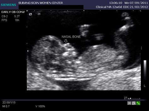 Ultrasound Nuchal Translucency