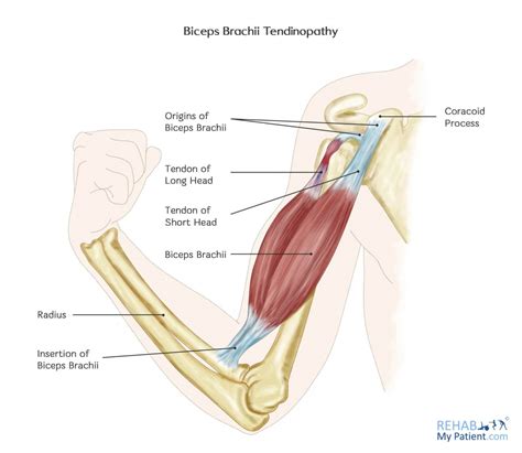 Biceps Brachii Tendinopathy | Rehab My Patient