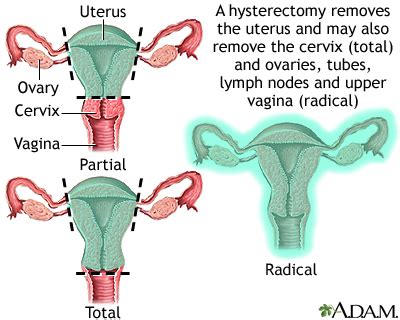 Hysterectomy: MedlinePlus Medical Encyclopedia