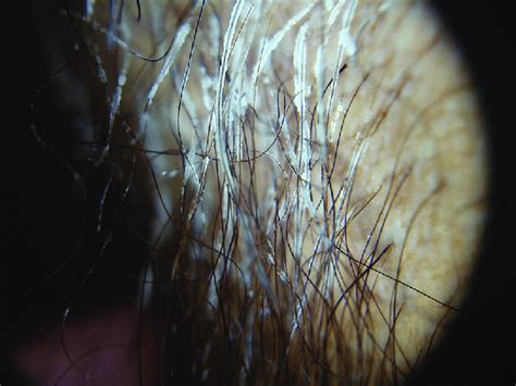 a: Dermatoscopic aspect of axillary hairs surrounded by nodules and ...