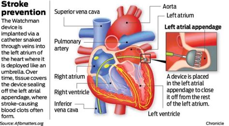 MAPMG Cardiologists Perform New Watchman Procedure, Reduce Risk of Stroke - Kaiser Permanente ...