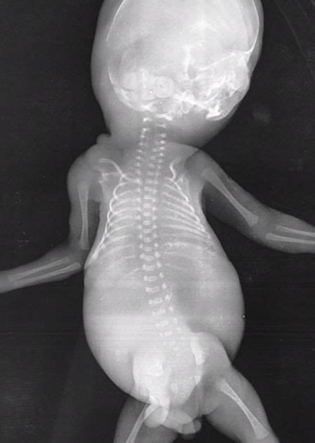 Prune belly syndrome | Radiology Case | Radiopaedia.org | Radiology ...