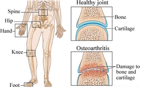 Osteoarthritis - What is?, Definition, ICD 9 Code, Symptoms, Treatment