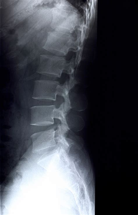 Genetics of Bone Density | National Institutes of Health (NIH)