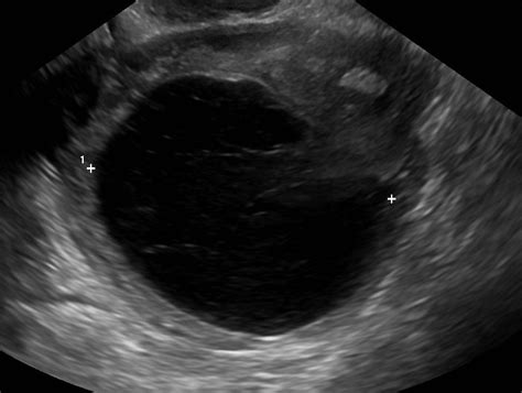 File:Haemorrhagic ovarian cyst ultrasound.jpg - Wikimedia Commons