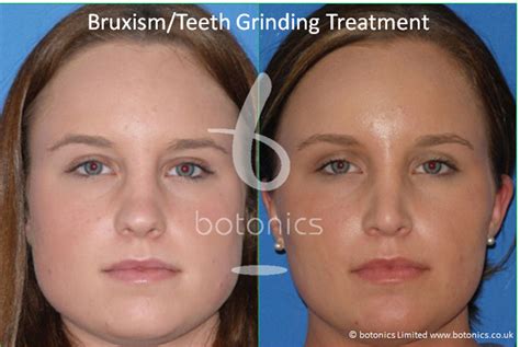 Bruxism Grinding Clenching Treatment with Botox - botonics