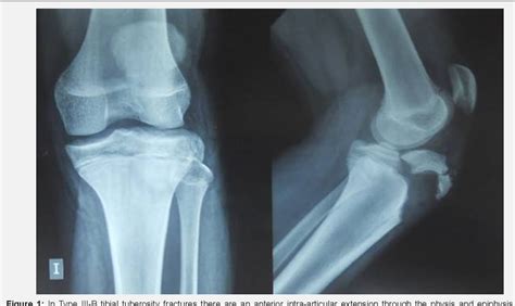 Figure 1 from Tibial Tuberosity Fracture (Type III-B) in Adolescents: Case Report | Semantic Scholar