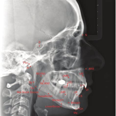 Mandibular plane angle (MPA), interincisal angle (IIA), intermolar... | Download Scientific Diagram