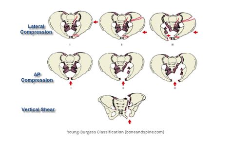 Pelvic Fractures — NUEM Blog