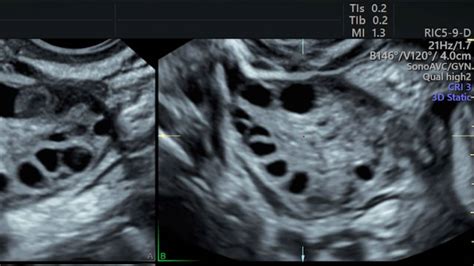 Comparing PCOS Ultrasound vs Normal Ultrasound: 3 Differences