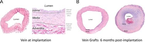 Vein histology at the time of graft implantation, demonstrating intimal ...