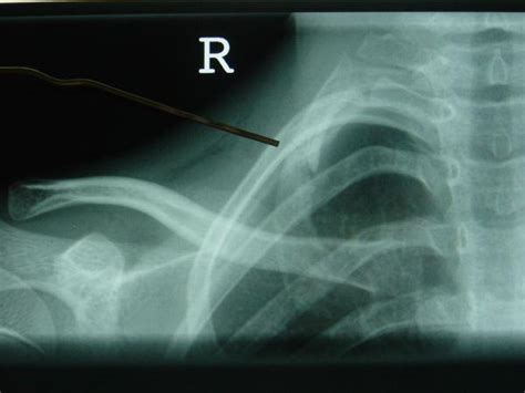 Isolated 1st rib fracture in a child | Eurorad