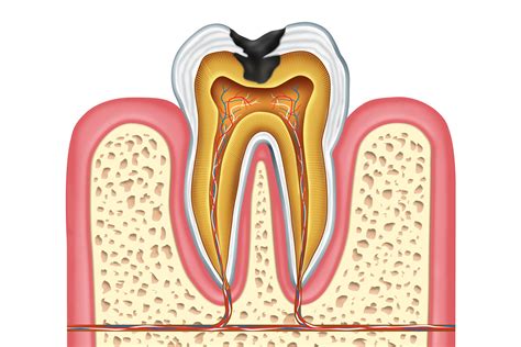 Houston, TX Cavities and Tooth Decay Treatments - Restorative Dentistry