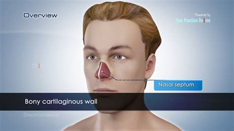 Watch Septoplasty Videos | Nasal Septum | YPO Education