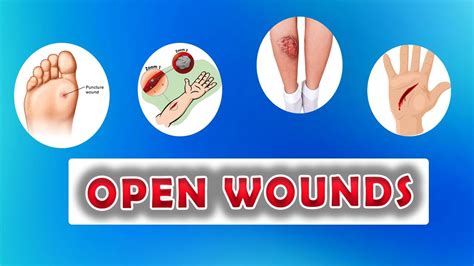 Types of Open Wounds (Abrasion, Laceration, Skin Avulsion, Puntured ...