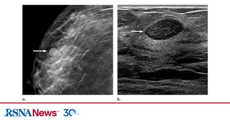 Six-Month Follow-Up Appropriate for BI-RADS 3 Findings on Mammography ...