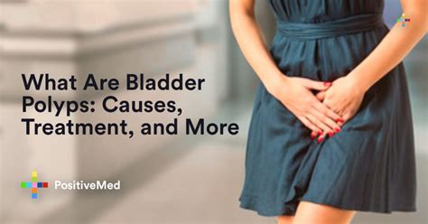 Bladder Polyps: Causes, Treatment, and More - PositiveMed