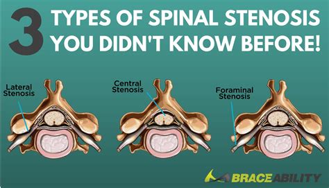 The Difference Between Foraminal, Central, & Lateral Recess Stenosis in Your Spinal Cord