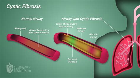 CF (Cystic Fibrosis) - St Vincent's Lung Health